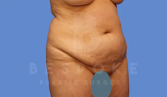 Mommy Makeover before at Dr. Broc Pratt - Bespoke Plastic Surgery in Charlotte, NC