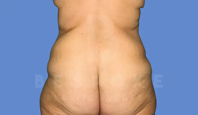 Thigh Lift before at Dr. Broc Pratt - Bespoke Plastic Surgery in Charlotte, NC