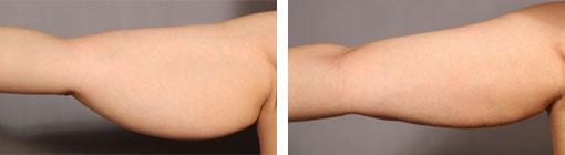 Michael G. Cedars, MD liposuction result — Oakland, CA