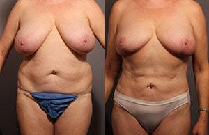 Michael G. Cedars, MD mommy makeover result — Oakland, CA