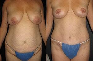 Michael G. Cedars, MD mommy makeover result — Oakland, CA