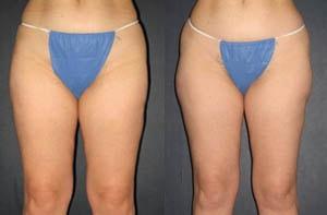 Michael G. Cedars, MD liposuction result — Oakland, CA