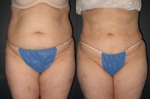 Michael G. Cedars, MD liposuction result — Oakland, CA