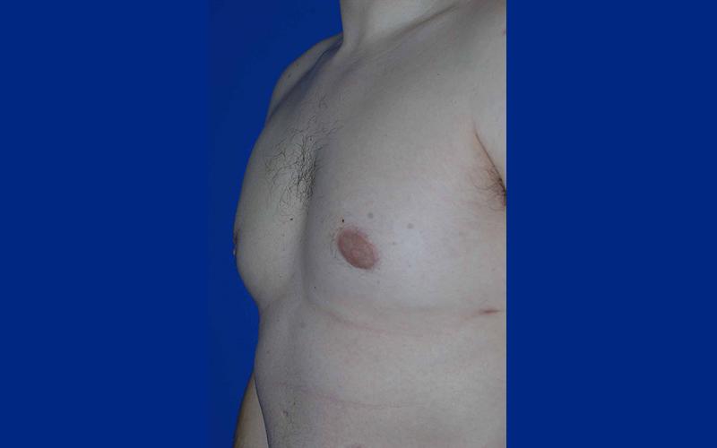 The Rose Clinic gynecomastia after — Orem, UT
