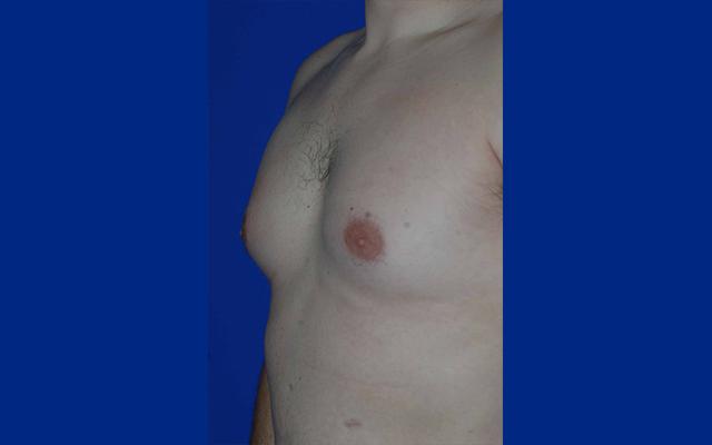 Gynecomastia Surgery before at The Rose Clinic in Orem, UT