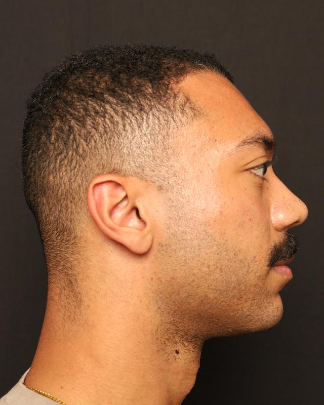 Jawline Filler after at The Rose Clinic in Orem, UT