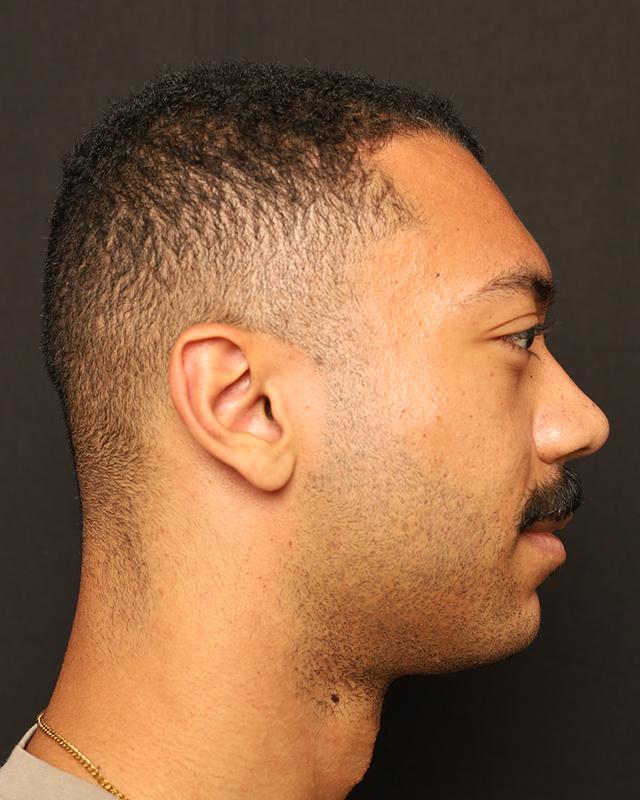 Jawline Filler before at The Rose Clinic in Orem, UT