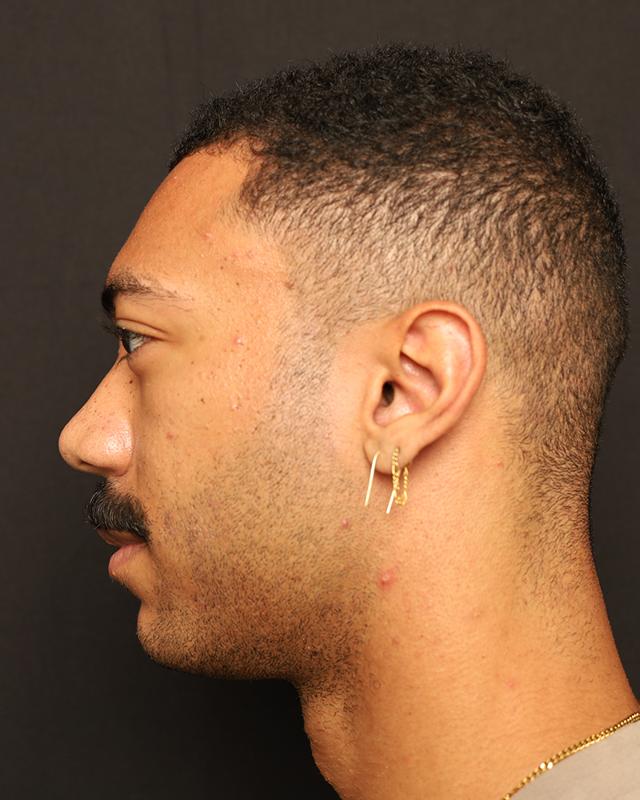 Dermal Fillers before at The Rose Clinic in Orem, UT