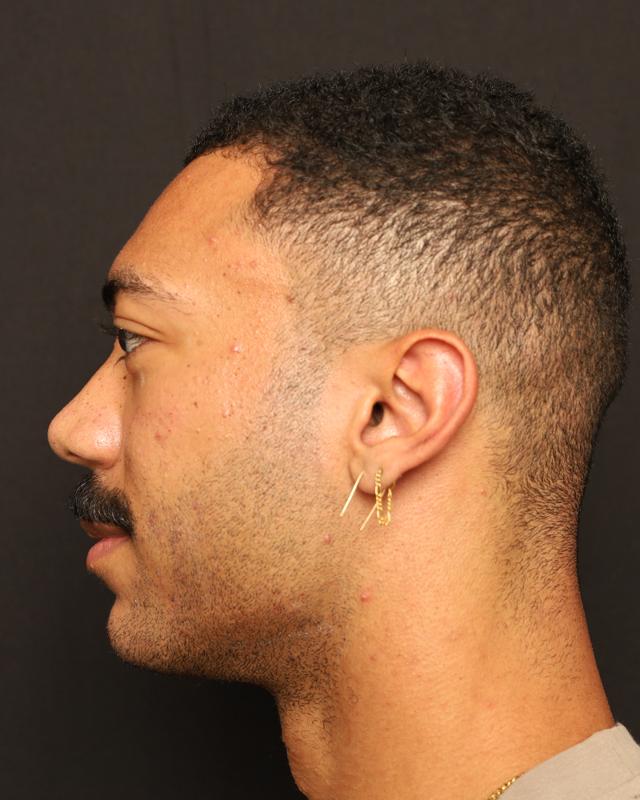 Jawline Filler after at The Rose Clinic in Orem, UT