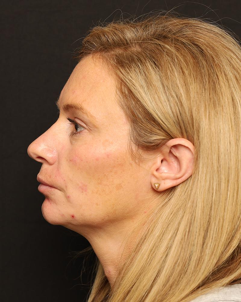 The Rose Clinic cheek filler after — Orem, UT