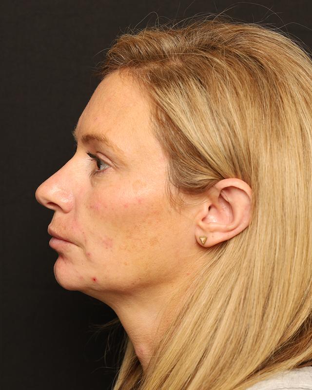 Dermal Fillers after at The Rose Clinic in Orem, UT