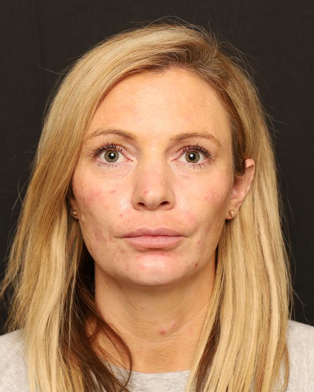 Dermal Fillers after at The Rose Clinic in Orem, UT