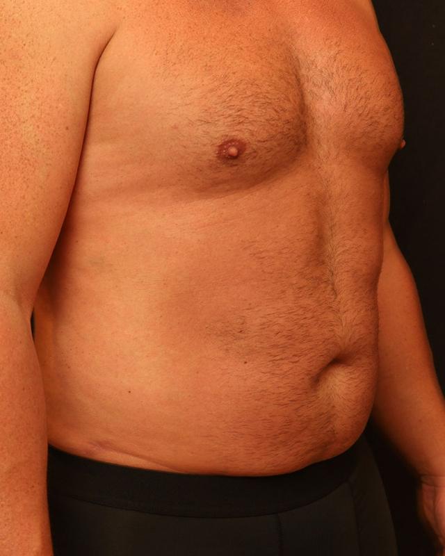 Liposuction after at The Rose Clinic in Orem, UT