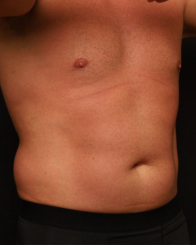Liposuction before at The Rose Clinic in Orem, UT