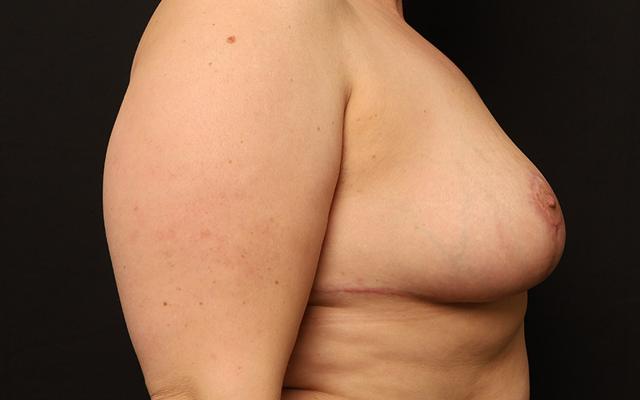 Breast Reduction after at The Rose Clinic in Orem, UT