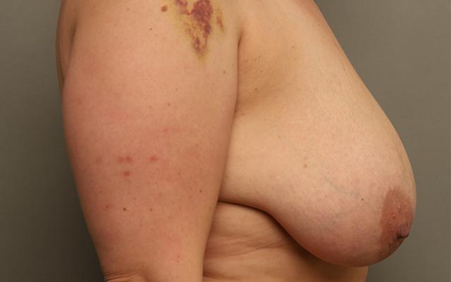 Breast Reduction before at The Rose Clinic in Orem, UT