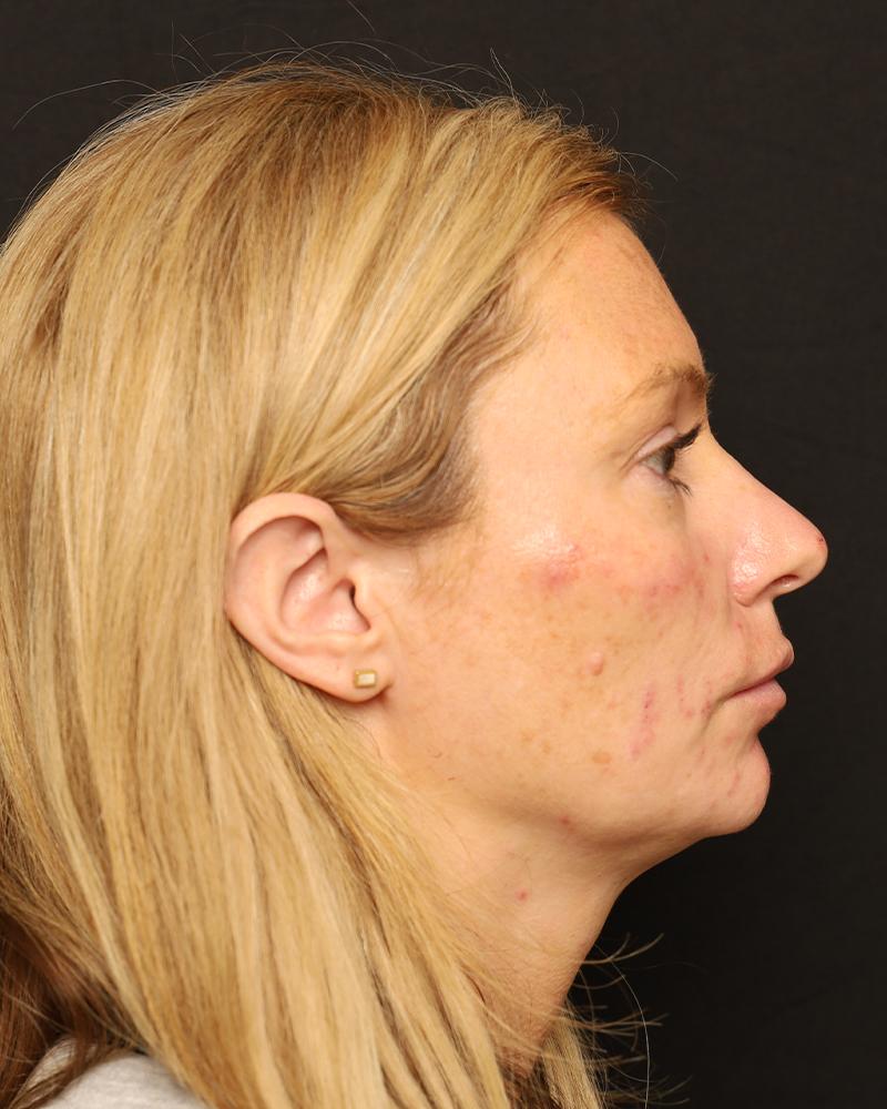 The Rose Clinic lip filler after — Orem, UT