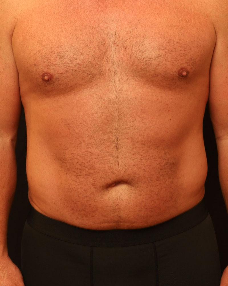 The Rose Clinic liposuction after — Orem, UT