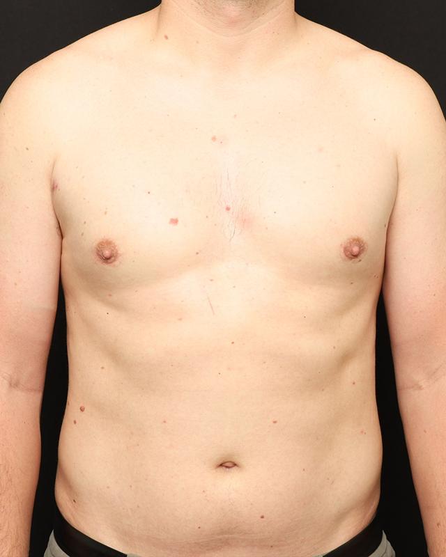 Gynecomastia Surgery after at The Rose Clinic in Orem, UT