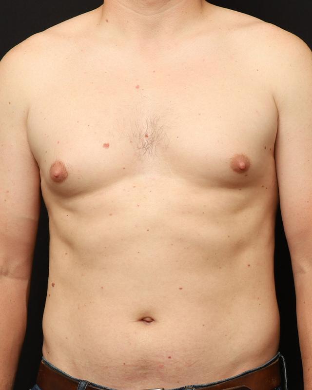 Gynecomastia Surgery before at The Rose Clinic in Orem, UT
