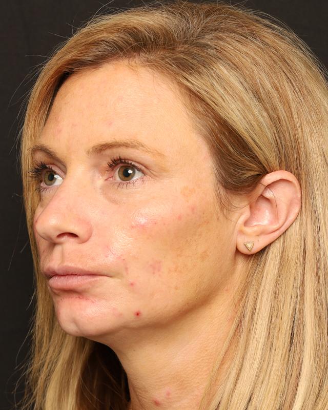 Lip Filler after at The Rose Clinic in Orem, UT
