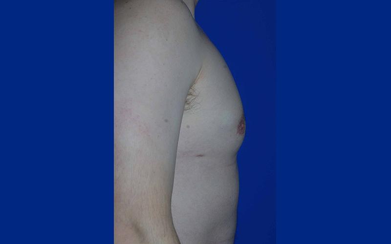 The Rose Clinic gynecomastia after — Orem, UT
