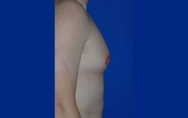Gynecomastia Surgery before at The Rose Clinic in Orem, UT