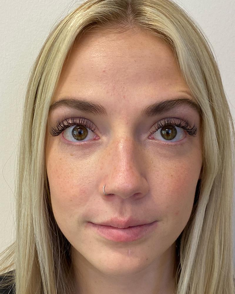 The Rose Clinic botox after — Salt Lake City, UT