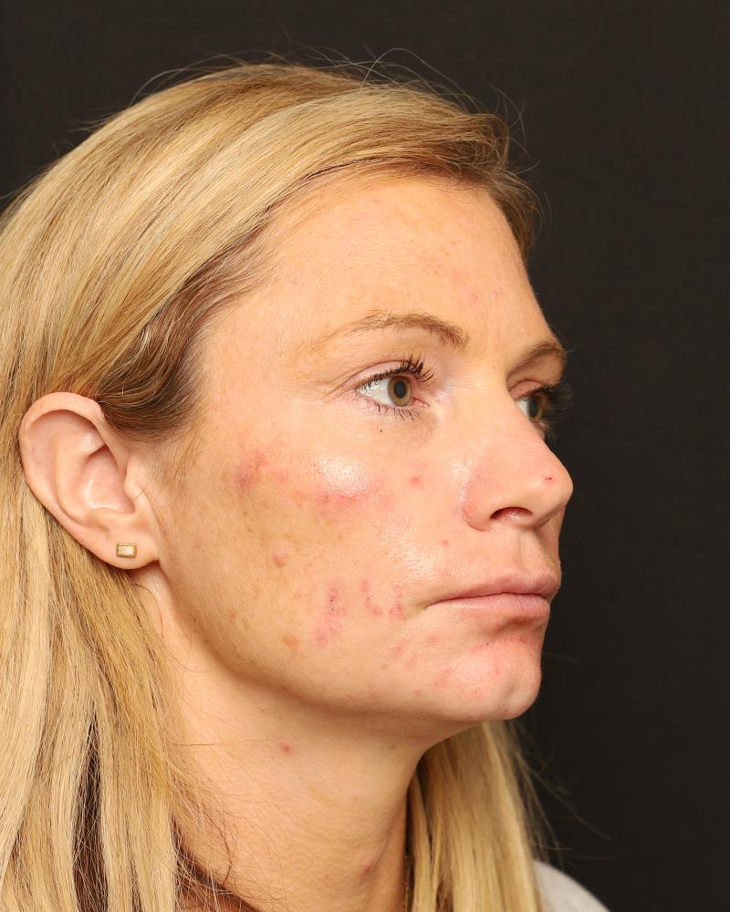 The Rose Clinic cheek filler after — Orem, UT