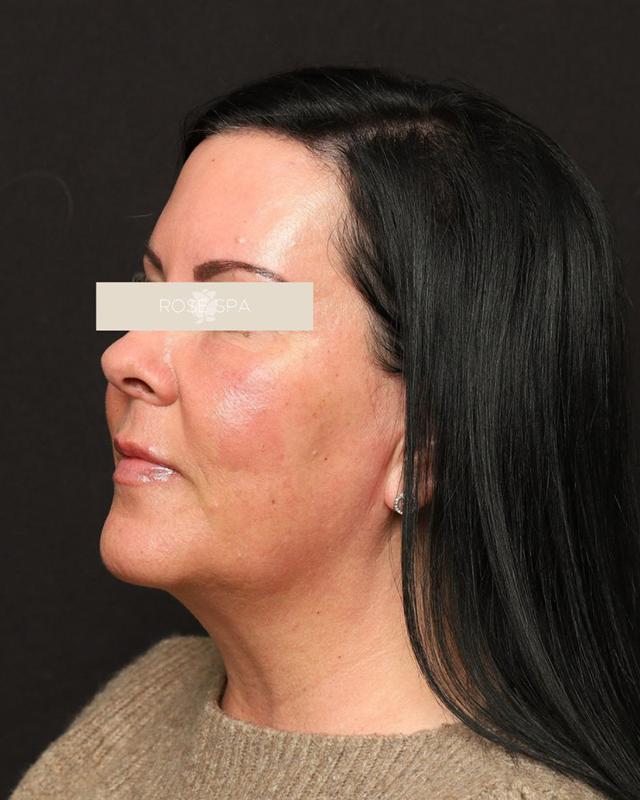 Dermal Fillers after at The Rose Clinic in Orem, UT