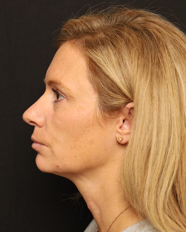 Dermal Fillers before at The Rose Clinic in Orem, UT