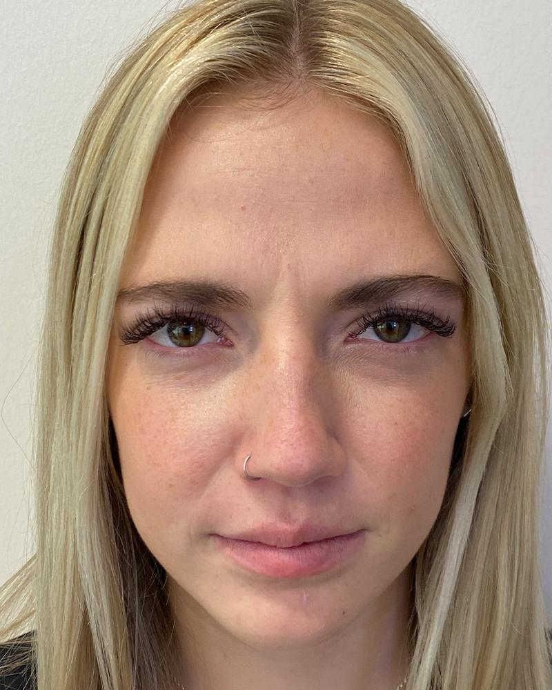 The Rose Clinic botox after — Salt Lake City, UT