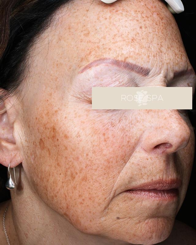 Laser Skin Resurfacing after at The Rose Clinic in Orem, UT