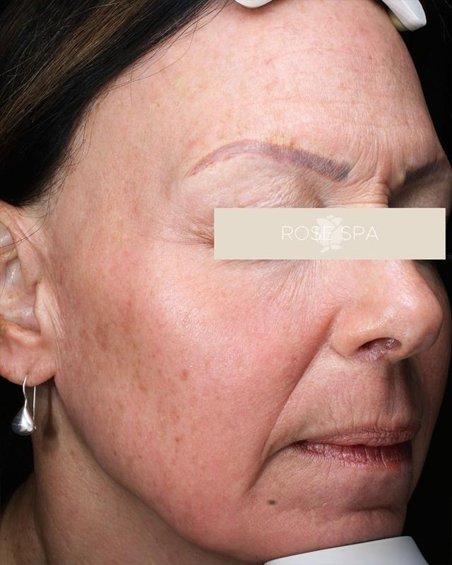 Laser Skin Resurfacing before at The Rose Clinic in Orem, UT