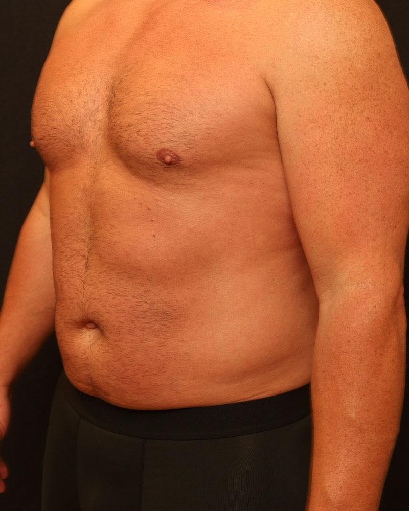 The Rose Clinic liposuction after — Orem, UT