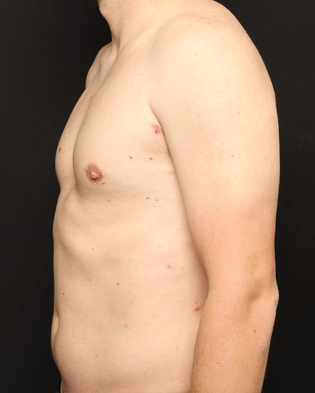 Gynecomastia Surgery after at The Rose Clinic in Orem, UT