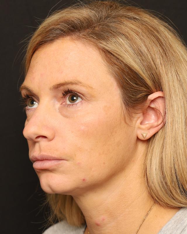Dermal Fillers before at The Rose Clinic in Orem, UT