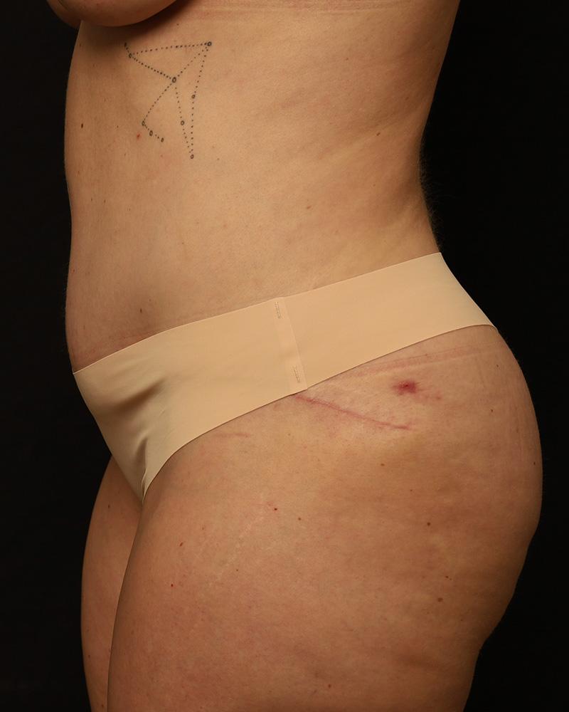 The Rose Clinic tummy tuck after — Orem, UT