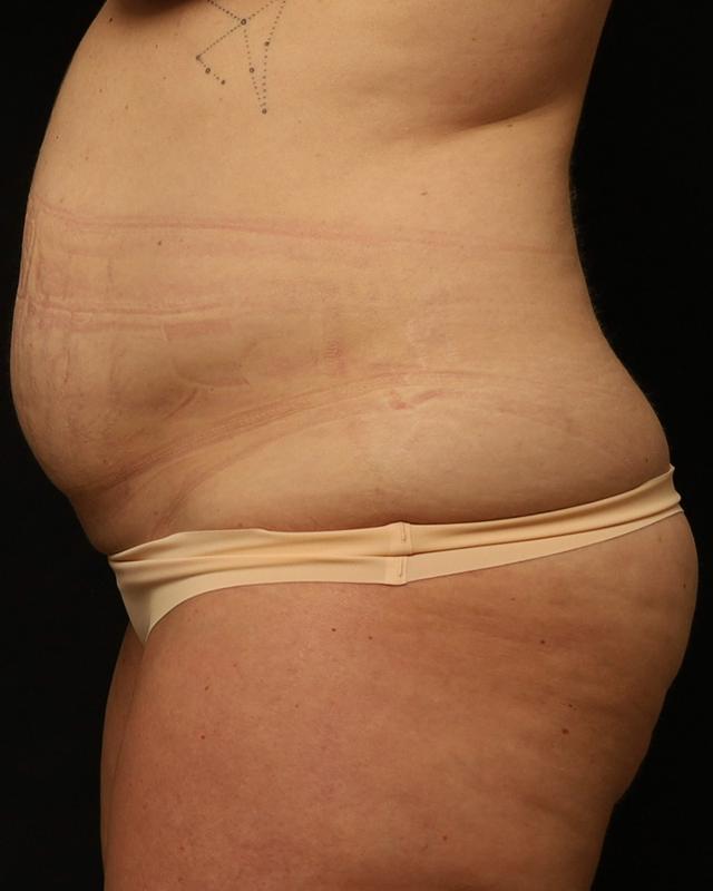Tummy Tuck before at The Rose Clinic in Orem, UT