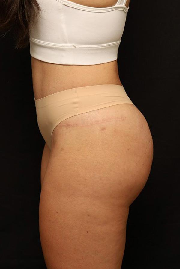 Brazilian Butt Lift after at The Rose Clinic in Orem, UT