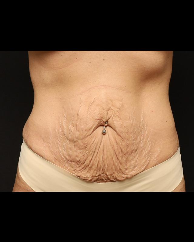 Tummy Tuck before at The Rose Clinic in Orem, UT