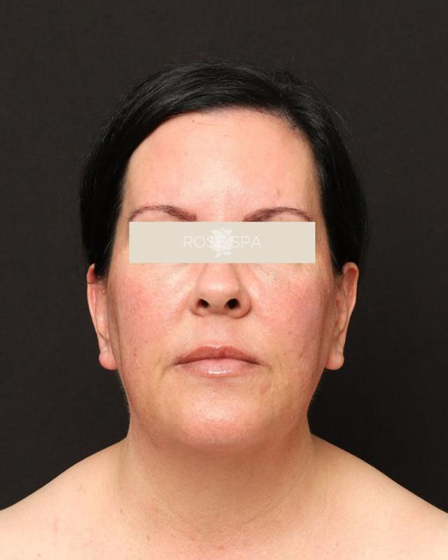 Laser Skin Resurfacing before at The Rose Clinic in Orem, UT