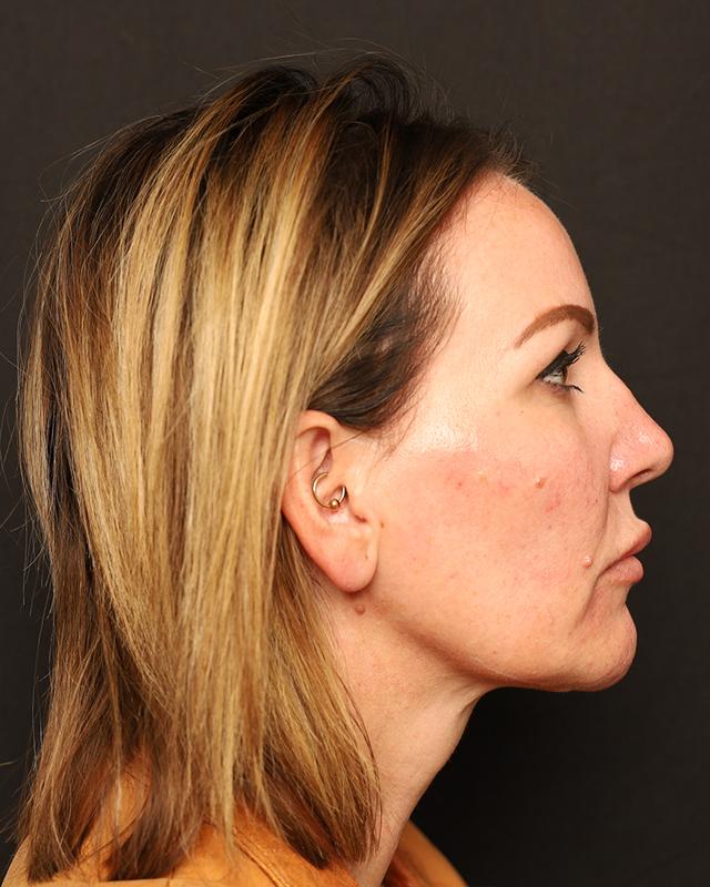 Dermal Fillers after at The Rose Clinic in Orem, UT