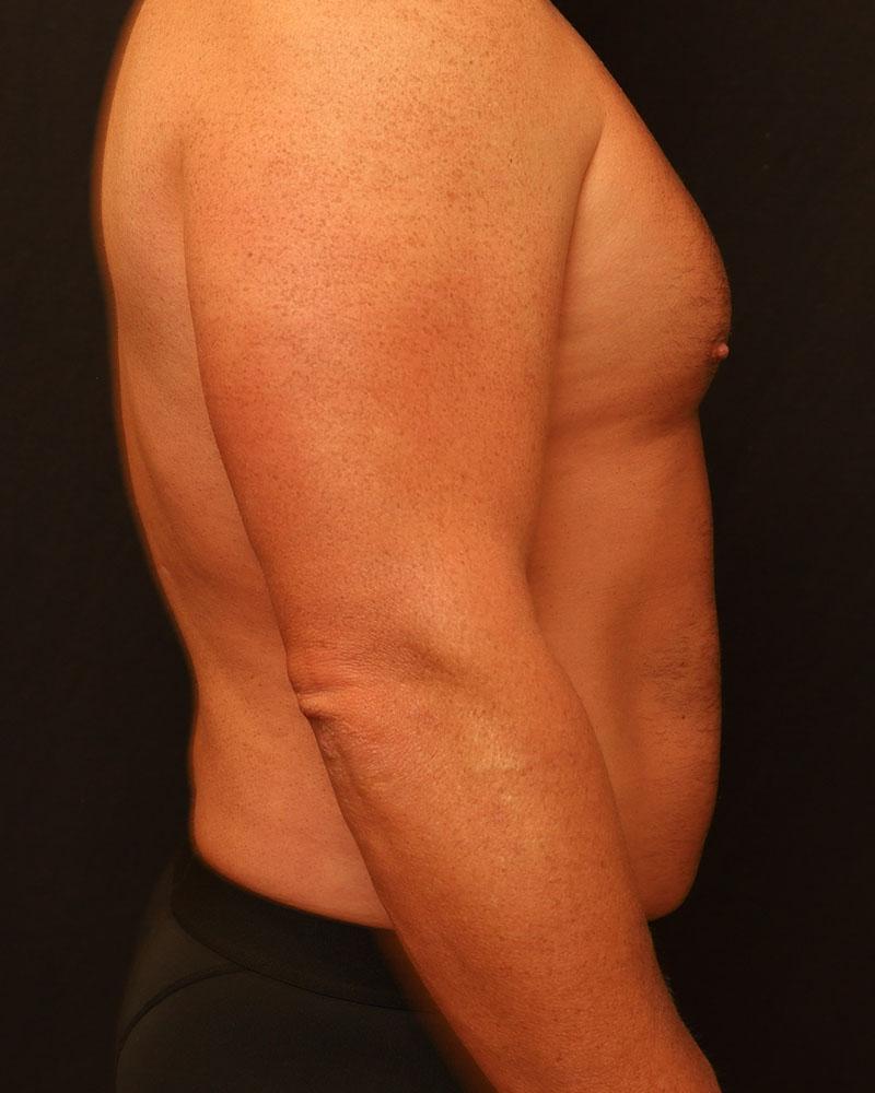 The Rose Clinic liposuction after — Orem, UT