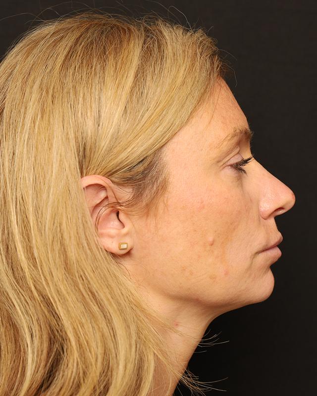 Dermal Fillers before at The Rose Clinic in Orem, UT