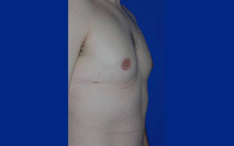 The Rose Clinic gynecomastia after — Orem, UT