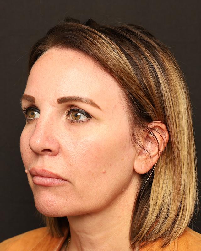 Dermal Fillers before at The Rose Clinic in Orem, UT