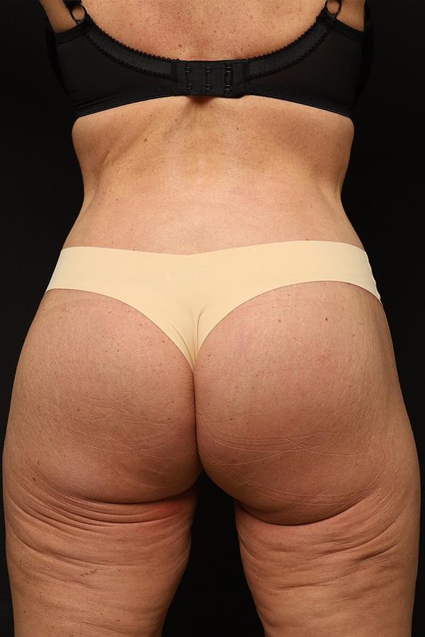 Brazilian Butt Lift after at The Rose Clinic in Orem, UT