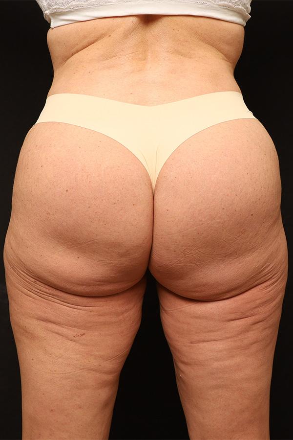 Brazilian Butt Lift before at The Rose Clinic in Orem, UT