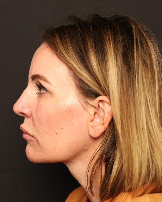 Dermal Fillers after at The Rose Clinic in Orem, UT